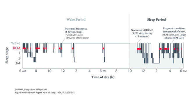 Pathophysiology of narcolepsy video thumbnail